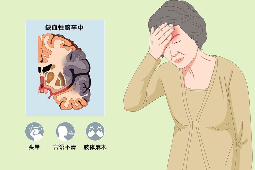 卒中是什么意思