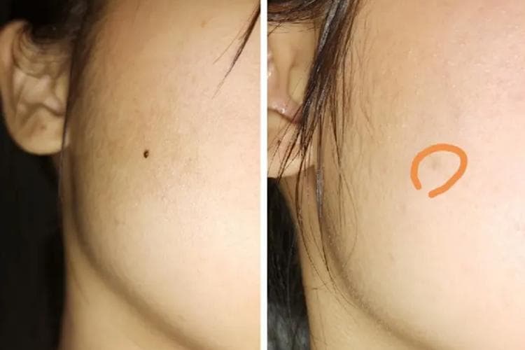 药水点痣可靠吗？医生解析其风险与局限性