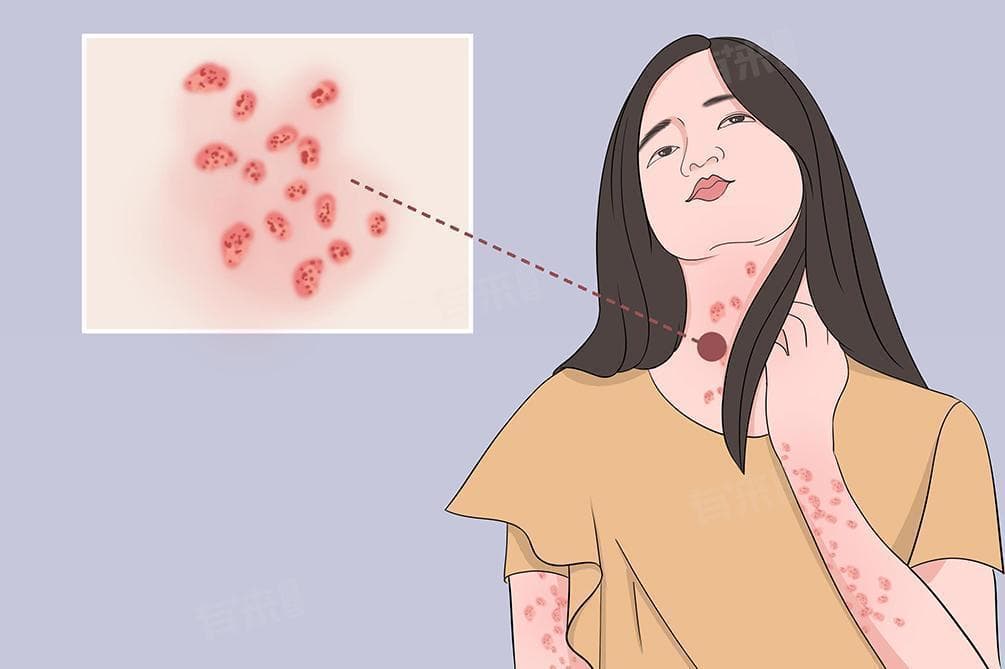 玫瑰糠疹的最佳治疗方法