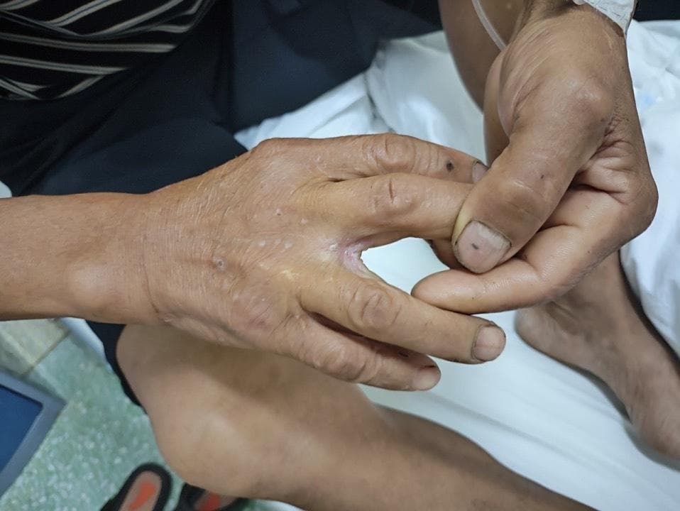 小伤口可能潜藏大风险！男子不慎割伤手指，数月后确诊败血症、全身多处感染