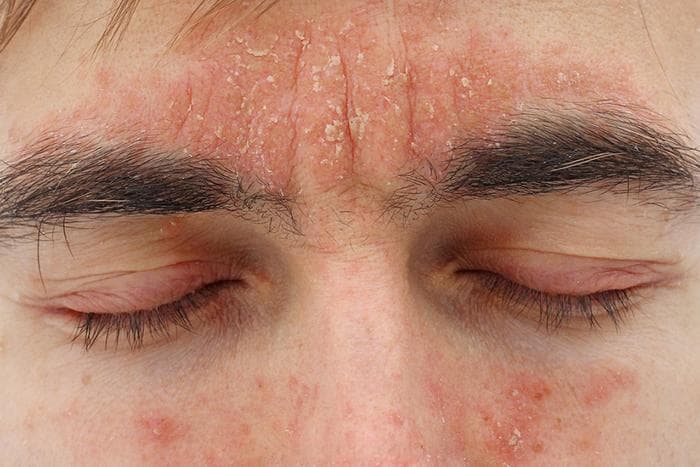 脂溢性皮炎：病因、症状与治疗方法全解析