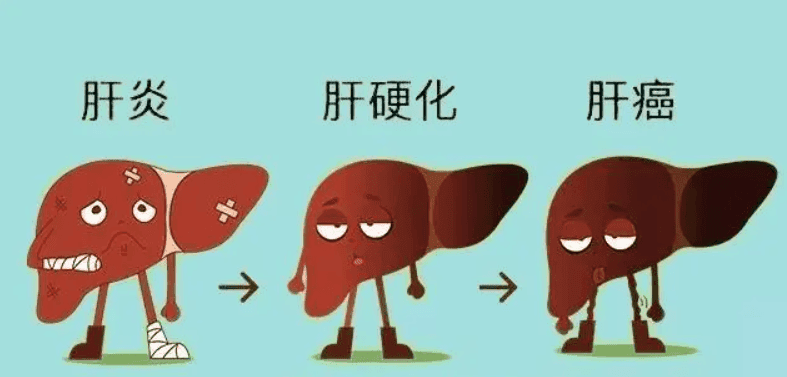 肝脏警示信号：如何识别并预防肝癌的风险因素