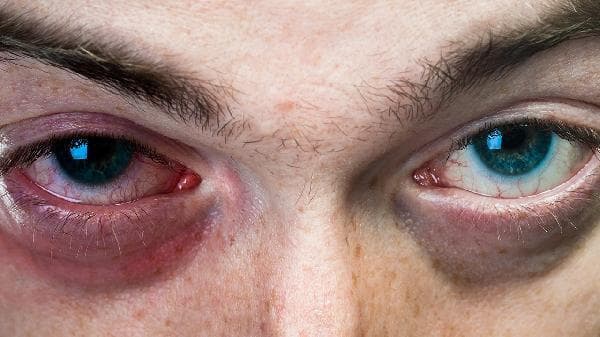 中医能治飞蚊症玻璃体混浊吗