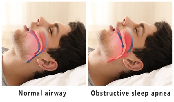睡眠呼吸障碍性疾病分为几类