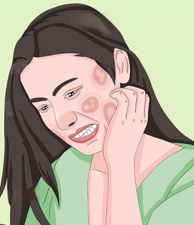 脸痒怎么缓解