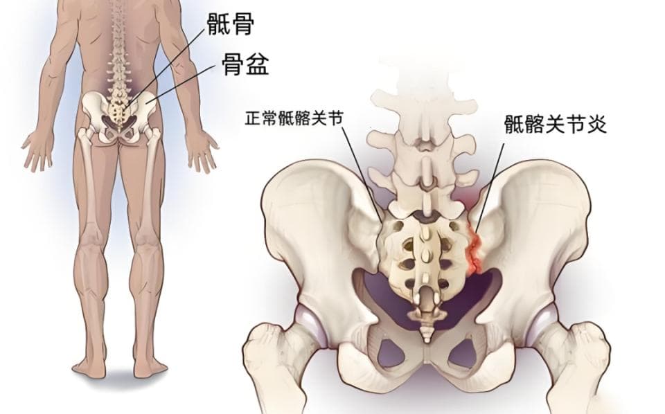 强直性脊柱炎患者的髋关节病变：为什么如此重要？