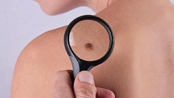 色素痣会自然消退吗？专业解析其形成、变化与治疗