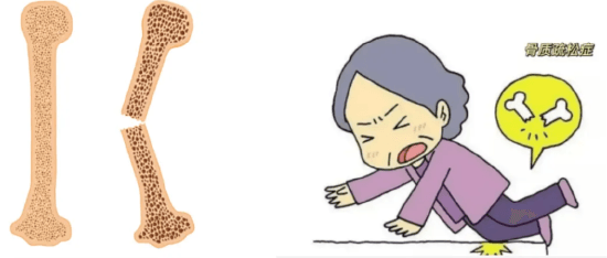 给骨骼做“体检”：骨质疏松早知道、早诊断