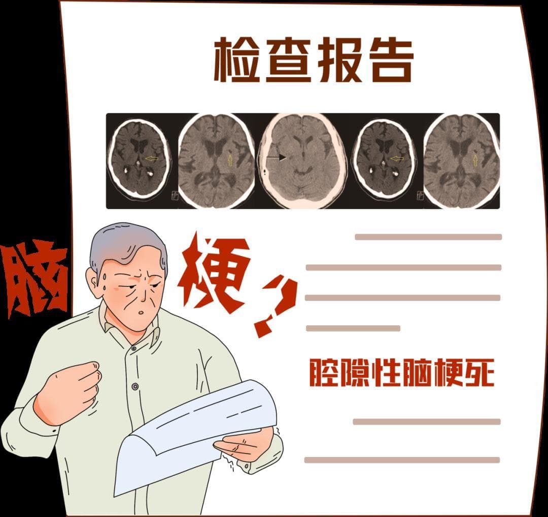 腔隙性脑梗死：从成因到预防的全面解析