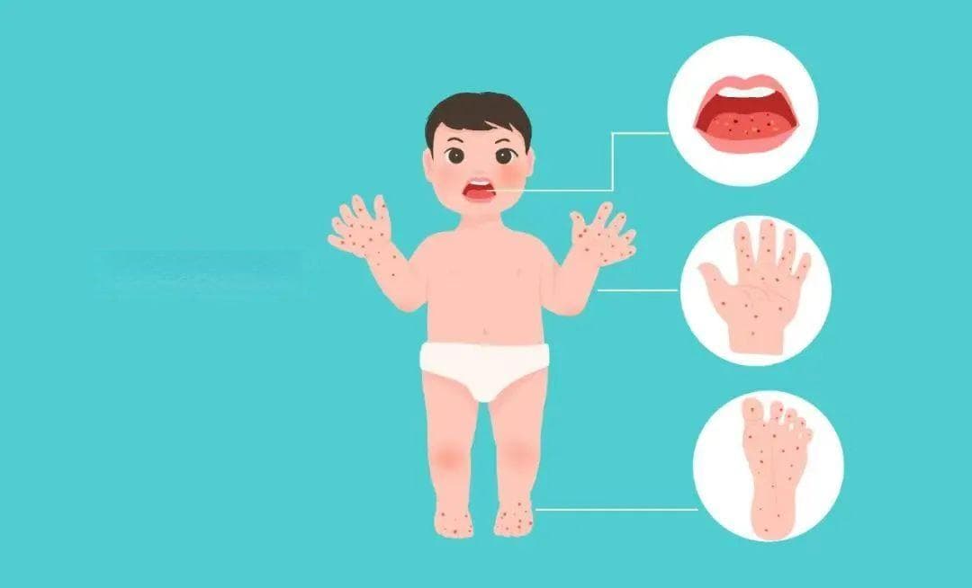 如何识别防治儿童手足口病