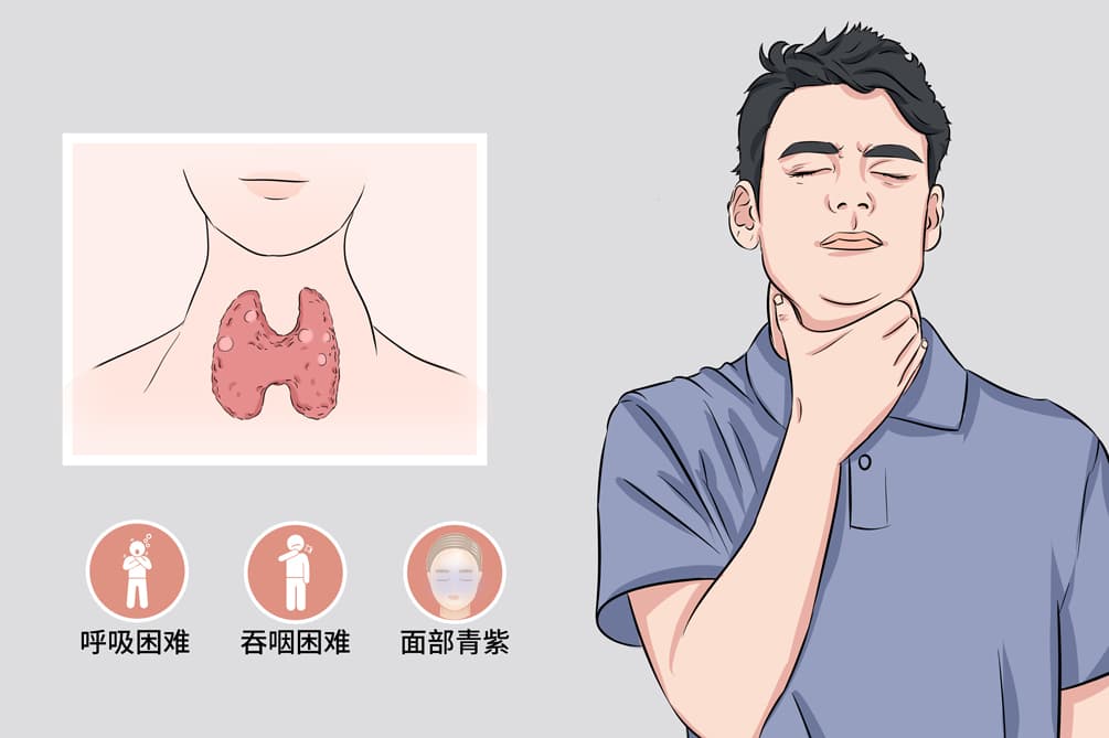 4A甲状腺结节可以消融吗？专业医生这样建议
