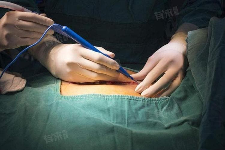 PCI手术是什么