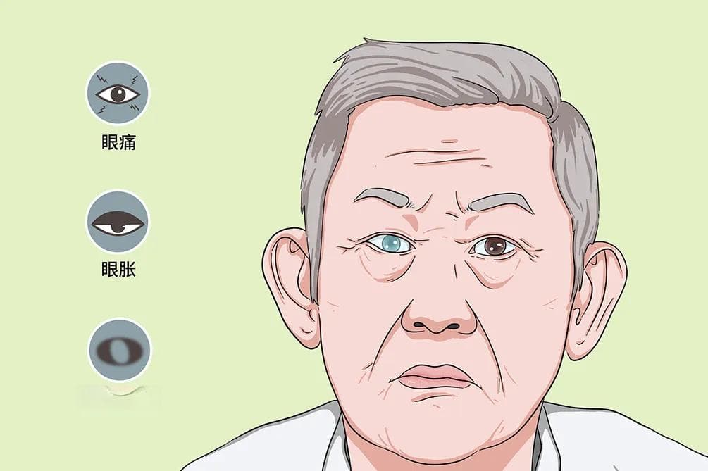 青光眼为什么叫青光眼