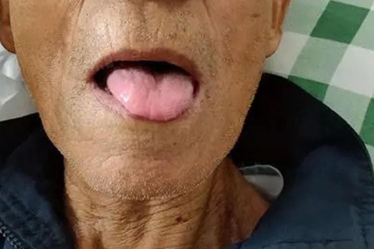 舌头发硬是什么病的前兆
