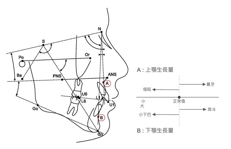 暴牙的种类与成因：骨性暴牙与齿性暴牙详解