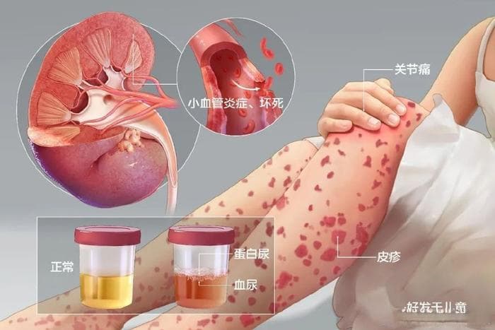 过敏性紫癜和血小板减少性紫癜有何差异？如何区分？