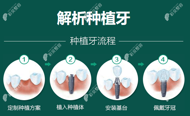 瑞典种植牙品牌排行榜及价格表：除诺贝尔外这几种植体也好
