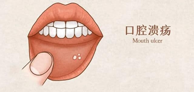 口腔溃疡外用药，你选对了吗？