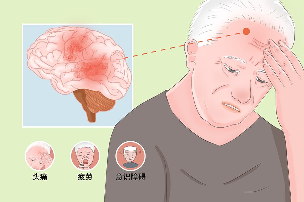 脑部T2FLAIR呈高信号严重吗