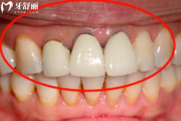 牙龈变黑了还能吗？盘点变色的原因和应对措施