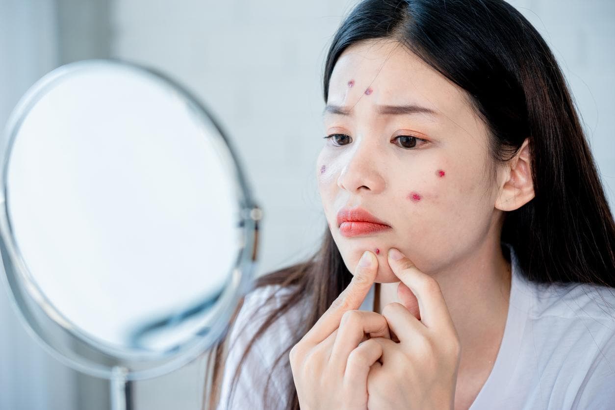 【痘痘位置】人中、身体长痘痘好困扰？一文了解不同部位爆痘原因＋解决方案！