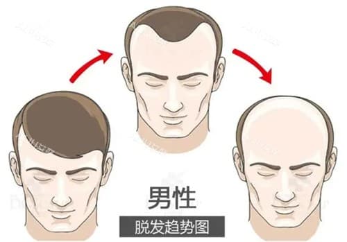 植发一平方厘米需要多少毛囊？科普一下植发密度/毛囊数量影响等