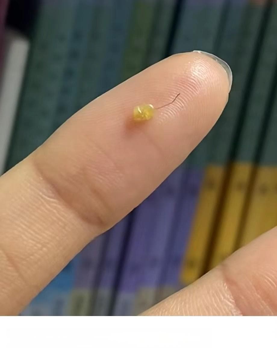 很多人都爱抠头皮上的小颗粒，它到底是什么啊？