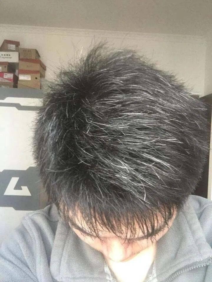 少年白头要治吗？该怎么治？
