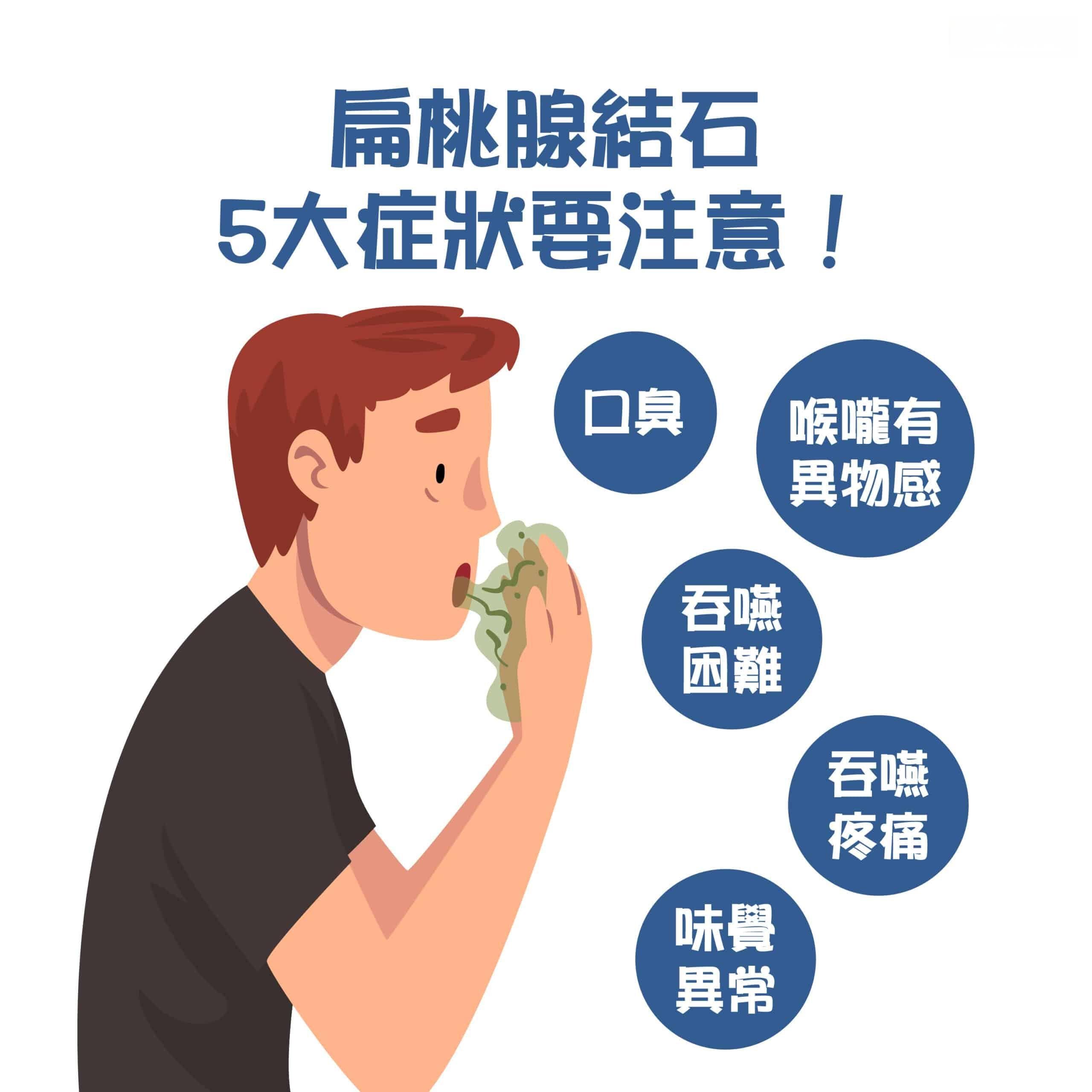 扁桃腺結石症狀引口臭！扁桃腺結石2原因，能自行清理嗎？