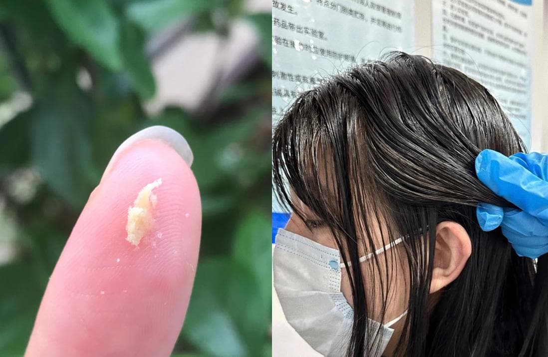 皮肤科医生揭秘洗发水真相：1000+案例解析头发护理难题