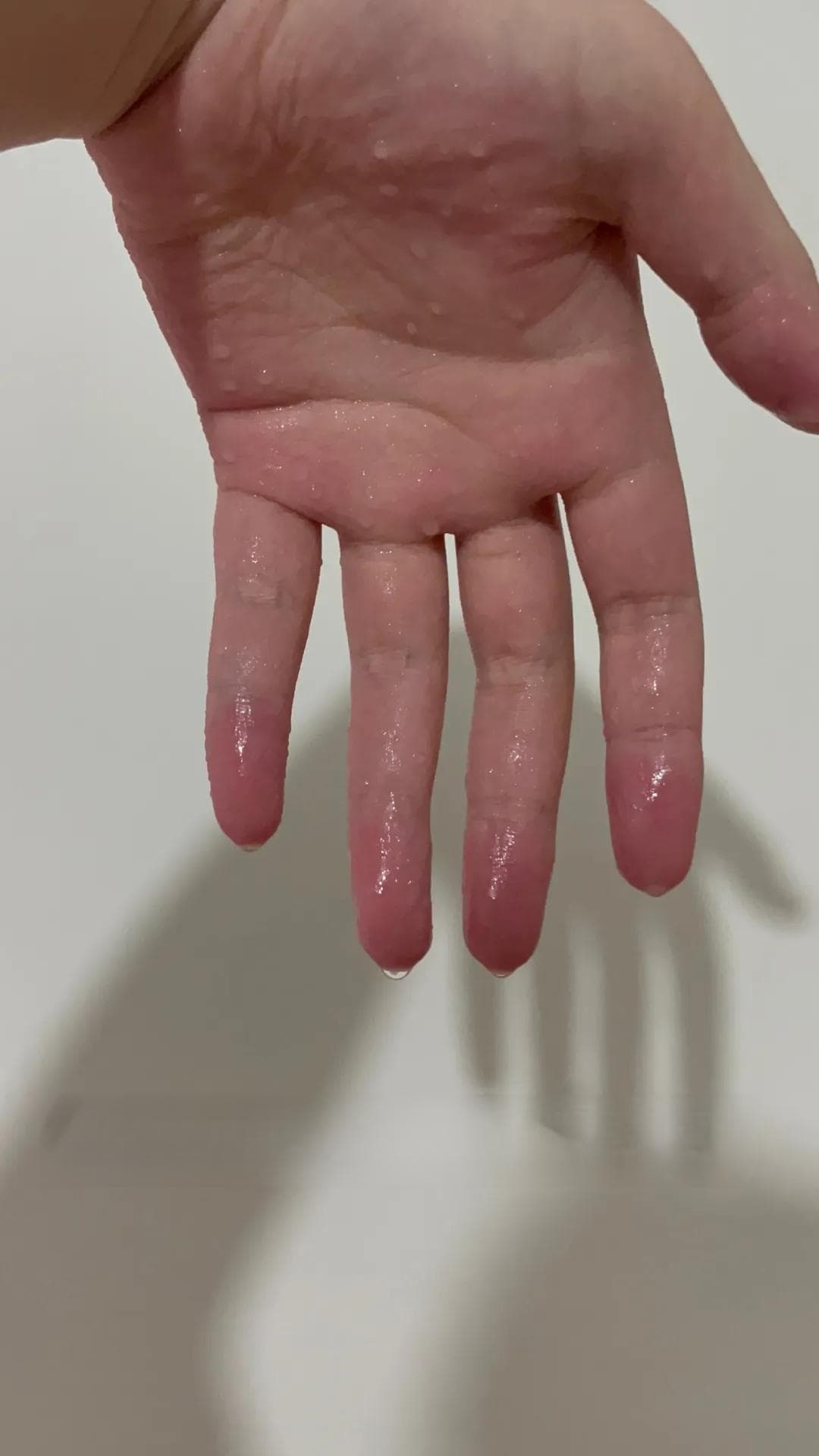 一到考试，手心狂冒汗？这种问题青少年最常见