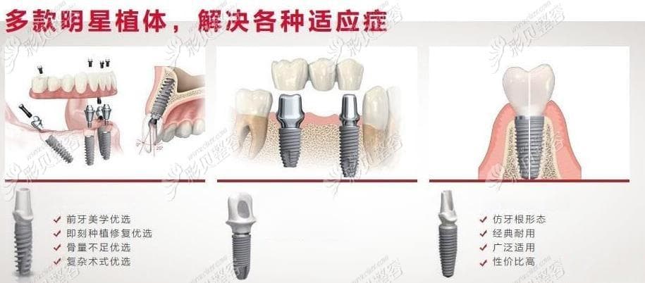 瑞典诺贝尔种植体三种型号详解：PCC、Replace、Active的优势与特点