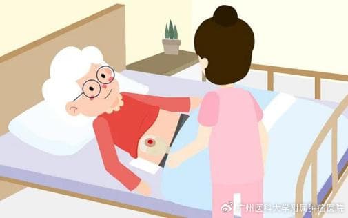护理专科| 关注饮食，“肠”享健康——造口患者应该怎么吃？