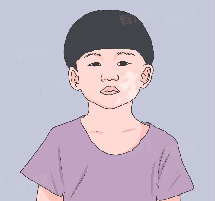 儿童长白色糠疹要紧吗