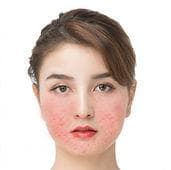 玫瑰痤疮是什么？症状、成因与治疗方法全解析