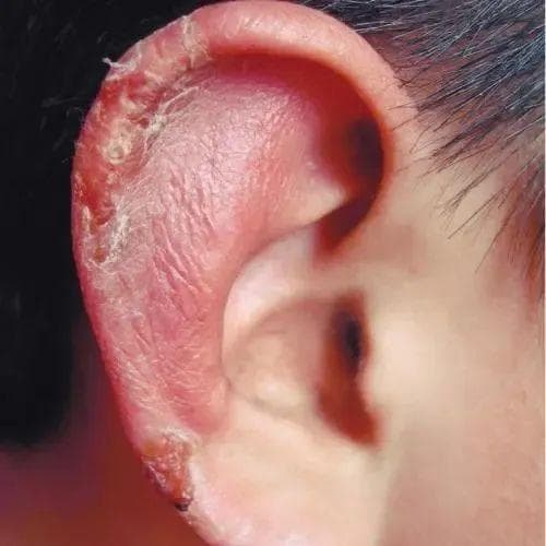 小心 “耳朵冻掉”啦，冬季寒潮来袭，如何护耳？