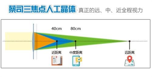 双焦点晶体和三焦点晶体区别对比，价格、适合人群、矫正原理等不同！