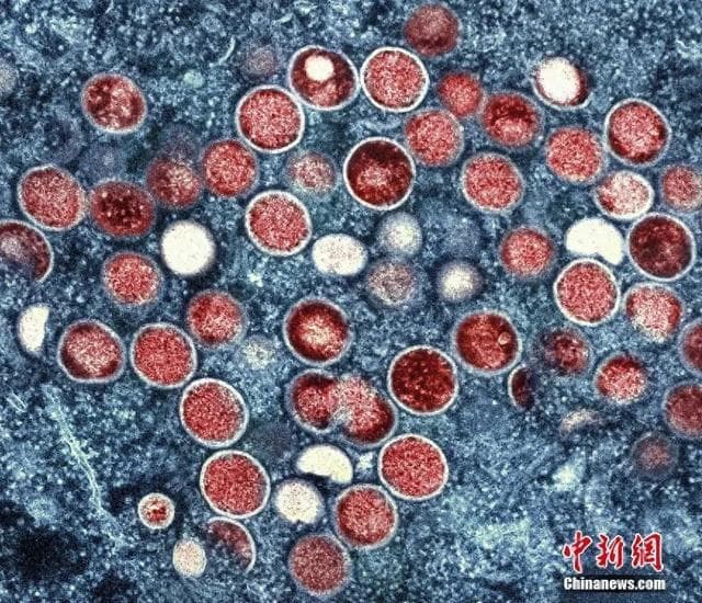 我国首次鉴定出猴痘新谱系，专家提醒：本土大流行可能性低