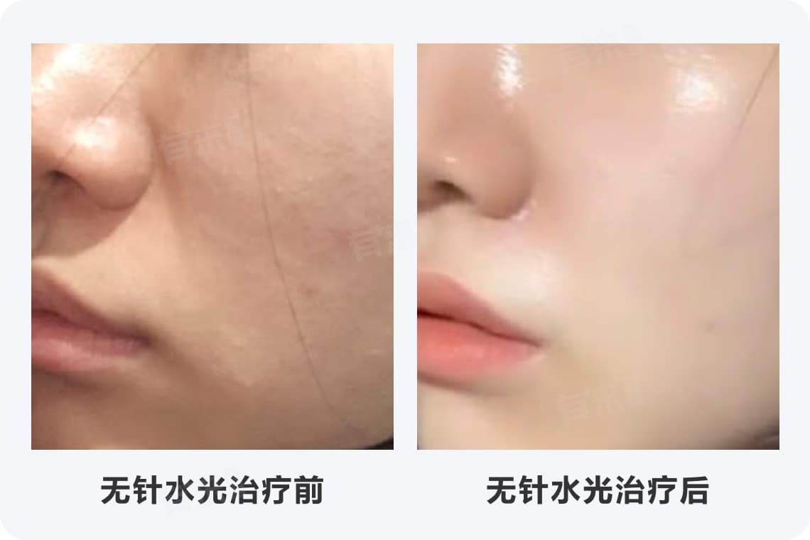 无针水光一个月做几次