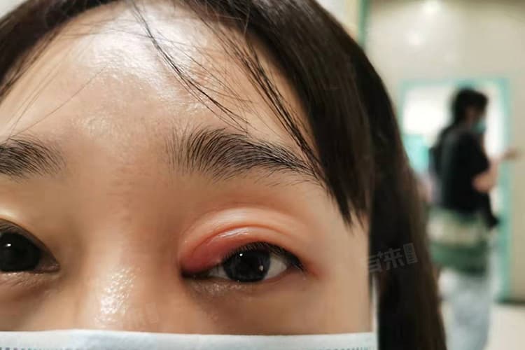 揭秘：眼皮肿了的八大原因及预防方法