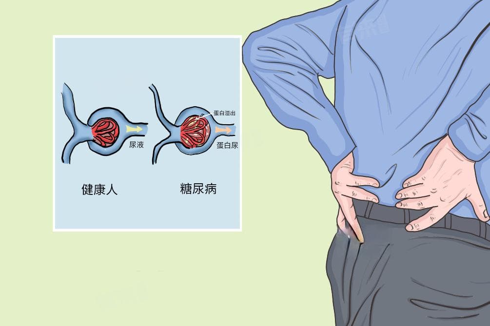糖尿病肾病发病机制及护理要点