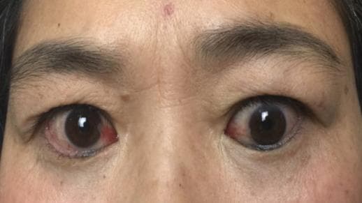 眼睛瞪得像“铜铃”，警惕甲状腺相关眼病