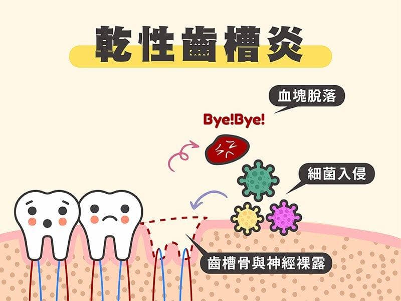 乾性齒槽炎是什麼？預防與常見4症狀