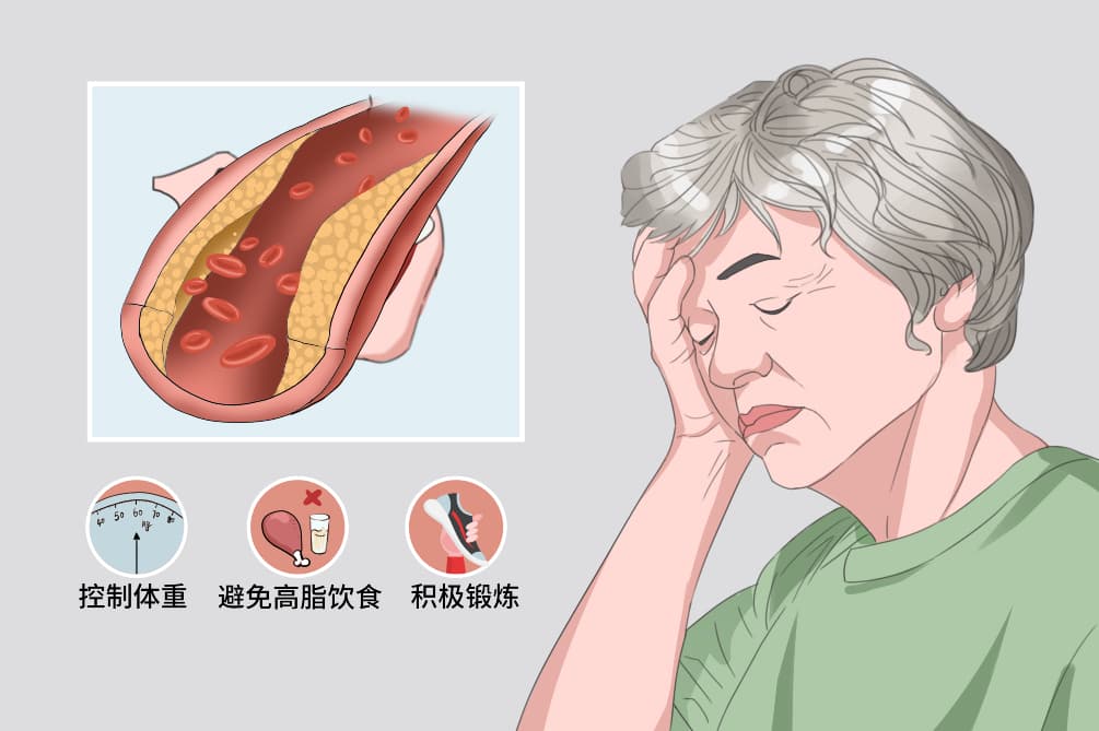 血脂化验指标字母全解析：从TC到ApoB