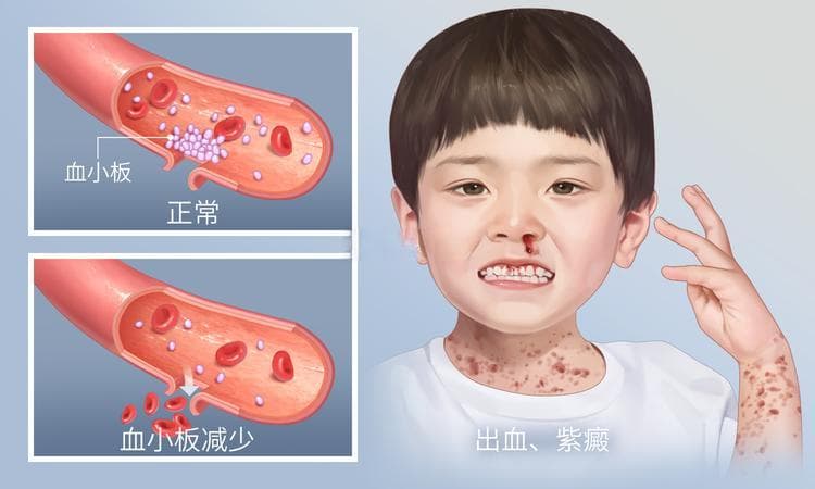 什么是血小板减少？症状、病因和治疗方法