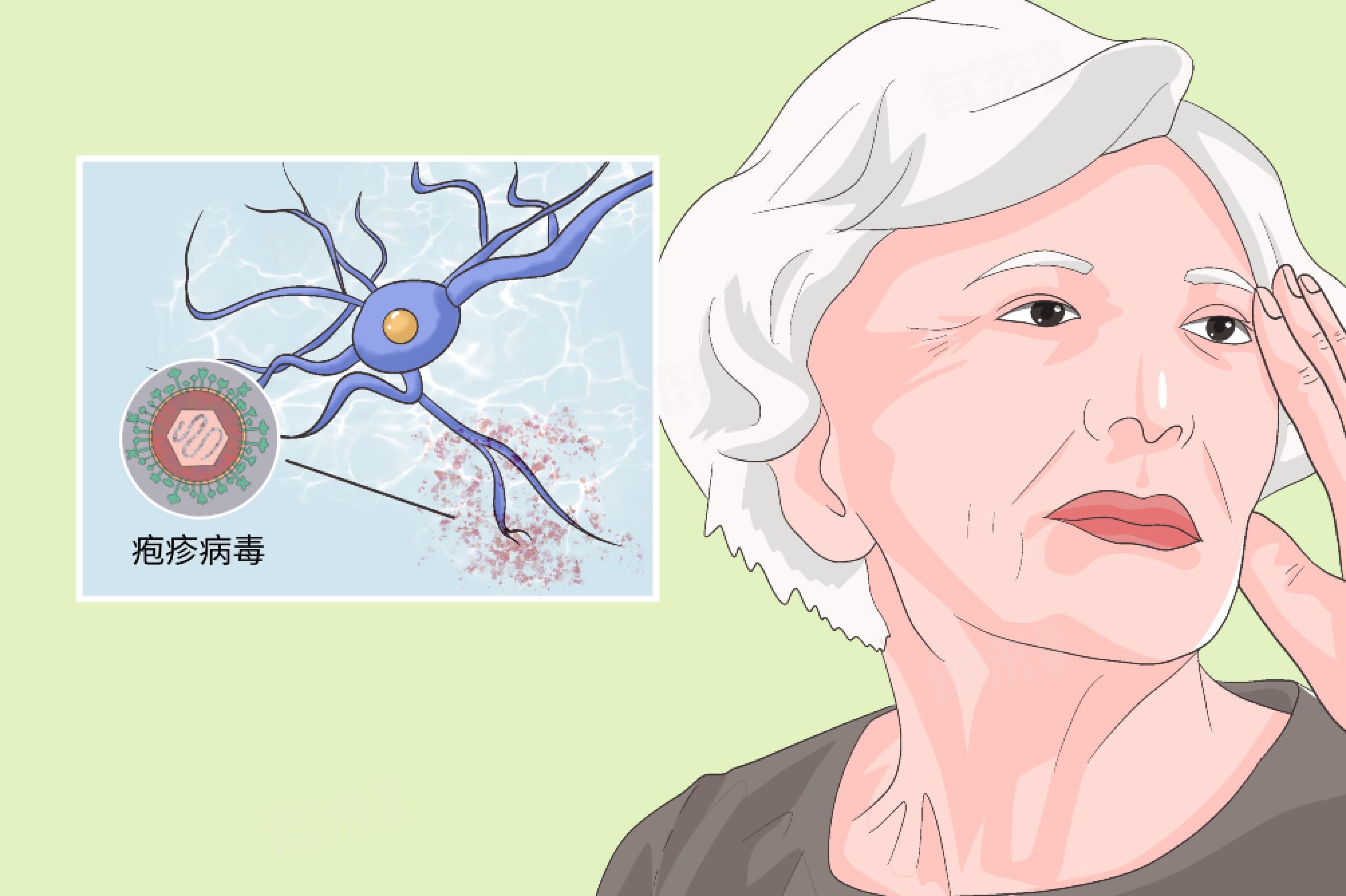 治疗带状疱疹后遗神经痛的首选方法