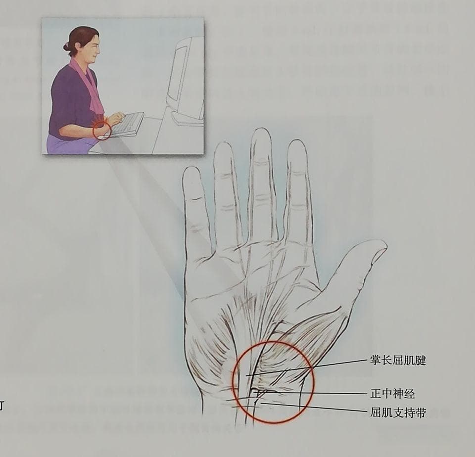 与腕关节有关的 5 种疼痛综合征