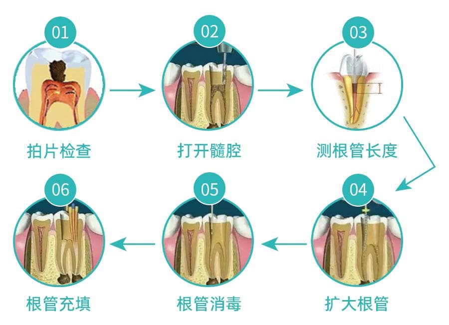 根管治疗的具体流程