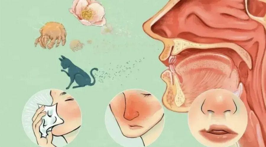 过敏性鼻炎——中医有良方