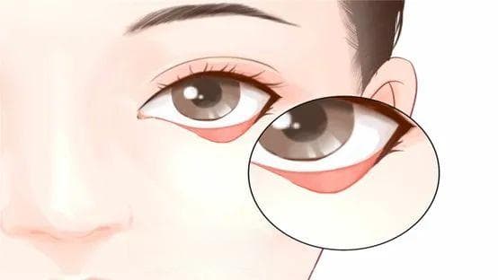 如何规范点眼药水？